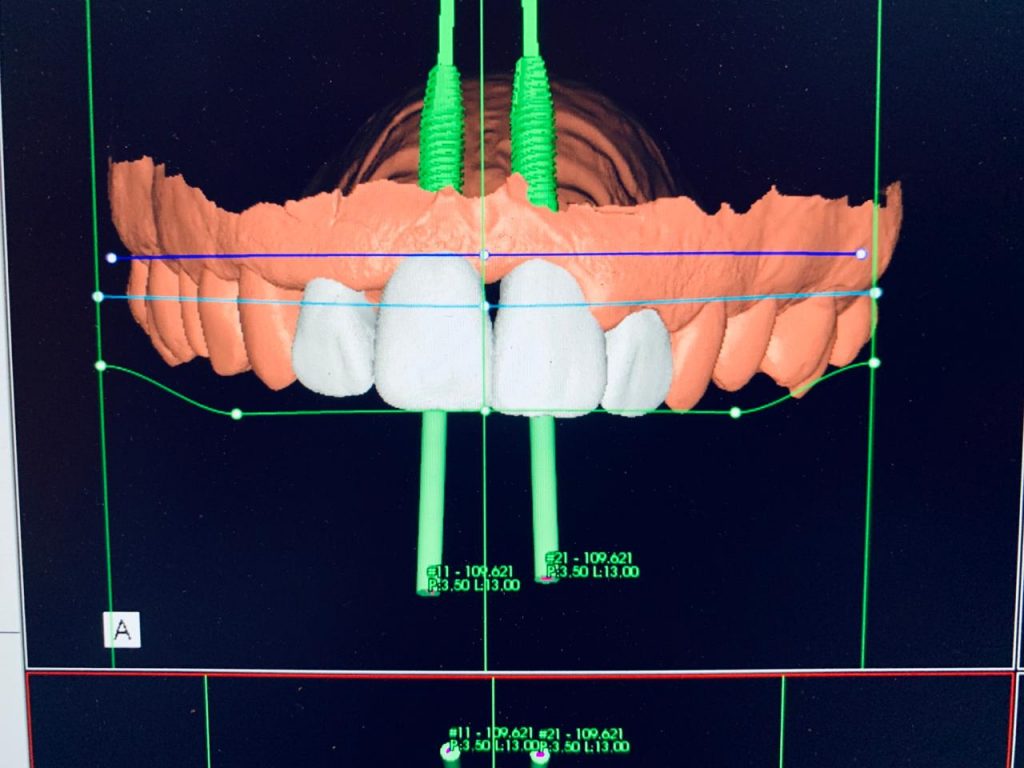 FLuxo Digital na Odontologia, Escaneamento Intra oral, Welson Pimentel, Dr. Welson Pimentel, Impressão 3D, Impressora 3D, Aula de exocad, Blender for dental, aulas de blender for dental, implantodontia, Impressão 3d na odontologia, Botafogo Dental Center, 3D Dentistry, Dentistry